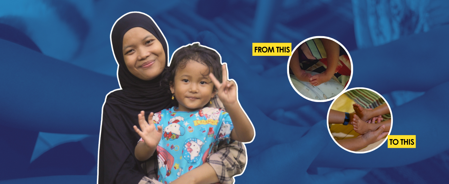 Kado Terindah di Usia 4 Tahun: Perjuangan Alesha Pulih dari Clubfoot/CTEV